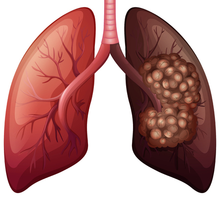 Cancer pulmon